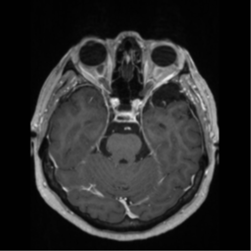 File:Anaplastic astrocytoma IDH wild-type (pseudoprogression) (Radiopaedia 42209-45276 Axial T1 C+ 55).png