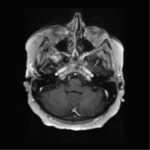 File:Anaplastic astrocytoma IDH wild-type (pseudoprogression) (Radiopaedia 42209-45279 Axial T1 C+ 34).png