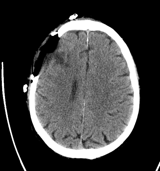 File:Anaplastic meningioma with recurrence (Radiopaedia 34452-35786 Axial non-contrast 22).png