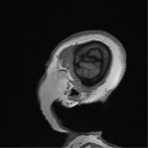 Anaplastic oligodendroglioma (Radiopaedia 83500-98599 Sagittal T1 58).png