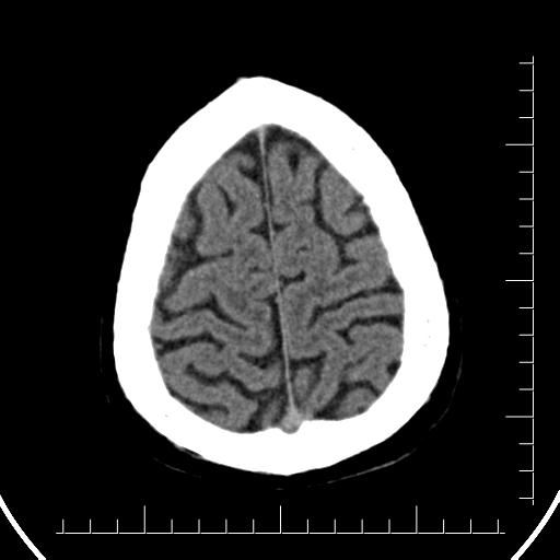 File:Aneurysm of posterior communicating artery (Radiopaedia 20188-20162 Axial non-contrast 42).jpg