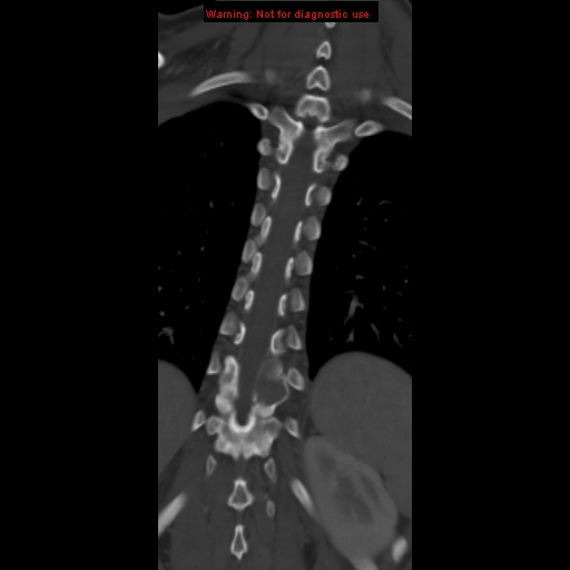 File:Aneurysmal bone cyst (Radiopaedia 9419-10102 Coronal bone window 15).jpg