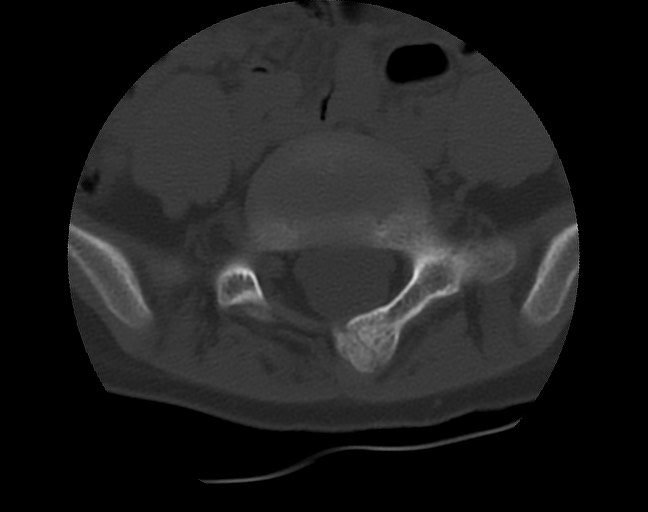 Aneurysmal bone cyst - sacrum (Radiopaedia 65190-74195 Axial bone window 14).jpg