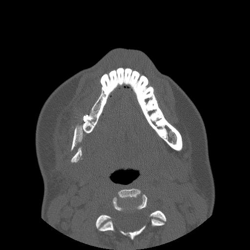 Aneurysmal bone cyst of the mandible (Radiopaedia 43280-46823 Axial bone window 48).jpg