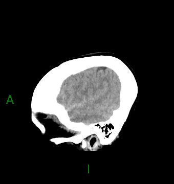 File:Aneurysmal subarachnoid hemorrhage with intra-axial extension (Radiopaedia 84371-99699 B 42).jpg