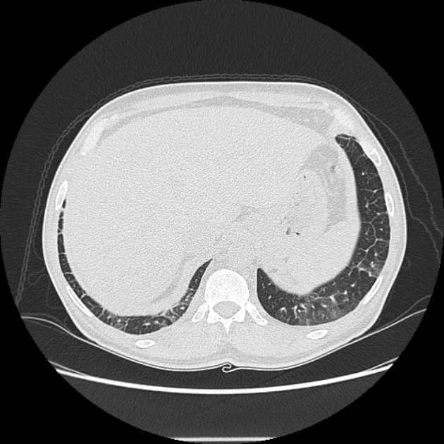 Angioinvasive aspergellosis (Radiopaedia 66995-76315 Axial lung window 47).jpg