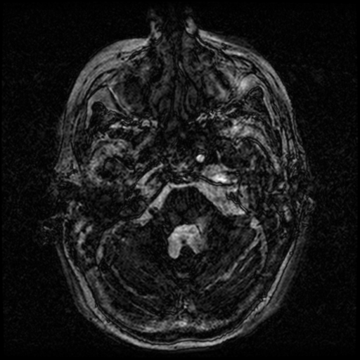 Angioinvasive aspergillosis in the pituitary fossa (Radiopaedia 39676-42010 Ax 3D FIESTA VOLUME 13).png