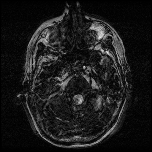 Angioinvasive aspergillosis in the pituitary fossa (Radiopaedia 39676-42010 Ax 3D FIESTA VOLUME 27).png