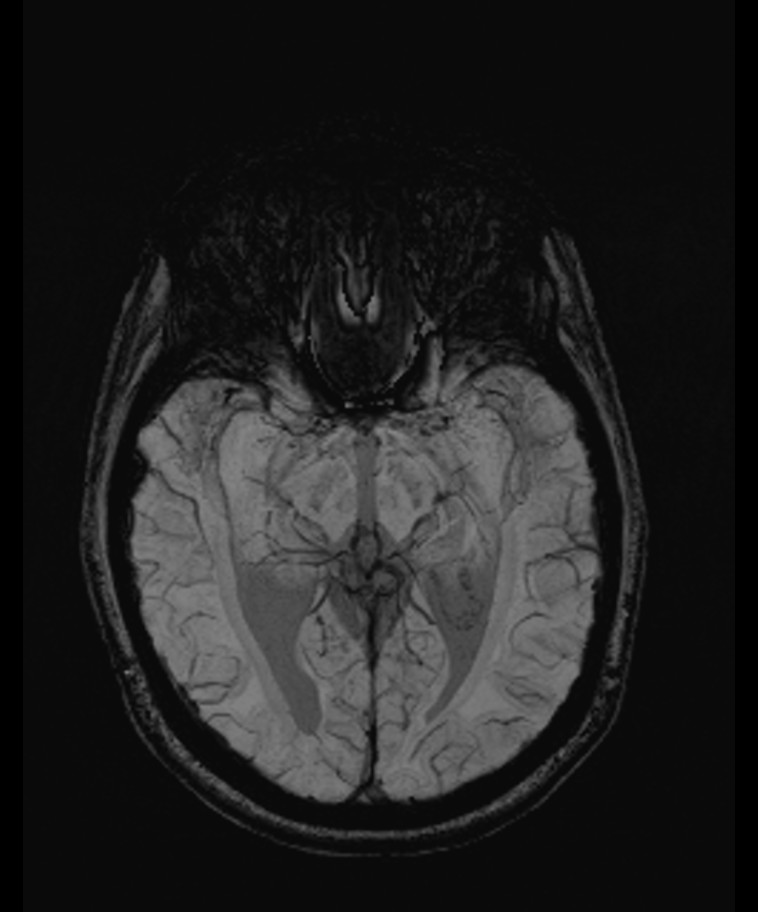 Angiomatous meningioma (Radiopaedia 79459-92579 E 29).jpg