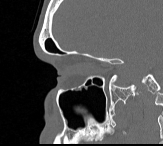 Angular epidermoid cyst (Radiopaedia 46908-51439 Sagittal bone window 26).png