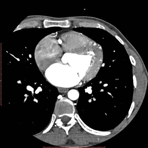 Anomalous left coronary artery from the pulmonary artery (ALCAPA) (Radiopaedia 70148-80181 A 179).jpg