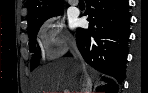 File:Anomalous left coronary artery from the pulmonary artery (ALCAPA) (Radiopaedia 70148-80181 C 31).jpg