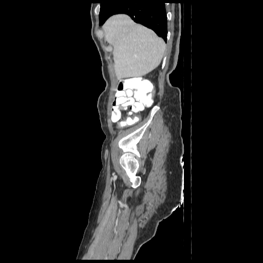 Anorectal carcinoma (Radiopaedia 44413-48064 C 10).jpg
