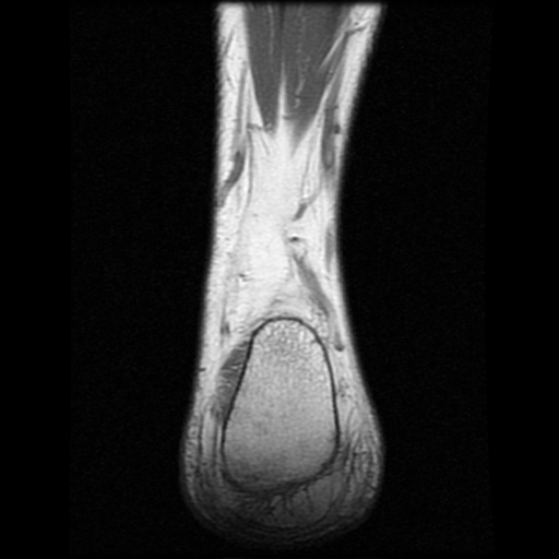File:Anterior calcaneal process fracture (Radiopaedia 74654-85611 Coronal T1 24).jpg