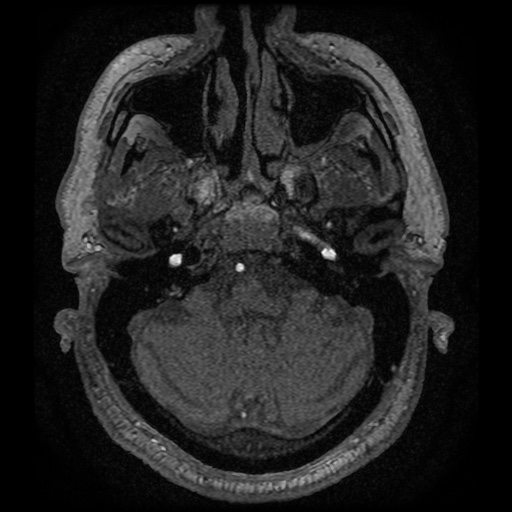 Anterior cerebral artery infarction (Radiopaedia 46794-51323 Axial MRA 16).jpg