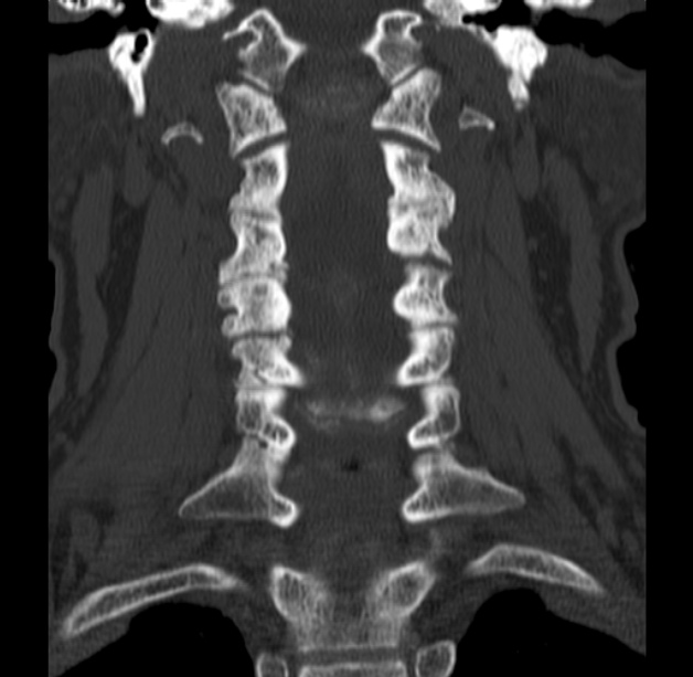 Anterior cervical postdiscectomy arthrodesis (Radiopaedia 32678-33646 Coronal bone window 31).jpg
