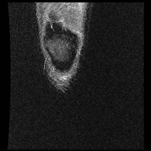File:Anterior cruciate ligament avulsion fracture (Radiopaedia 58939-66193 Coronal STIR 1).jpg