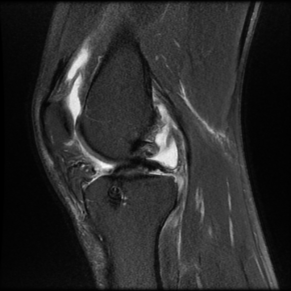 File:Anterior cruciate ligament graft tear and bucket-handle tear of medial meniscus (Radiopaedia 75867-87255 Sagittal PD fat sat 11).jpg