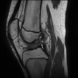 Anterior cruciate ligament tear - pediatric (Radiopaedia 62152-70260 Sagittal PD 90).jpg