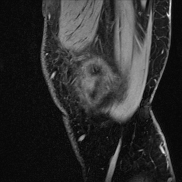 Anterior cruciate ligament tear - ramp lesion (Radiopaedia 71883-82322 Sagittal T1 vibe 129).jpg