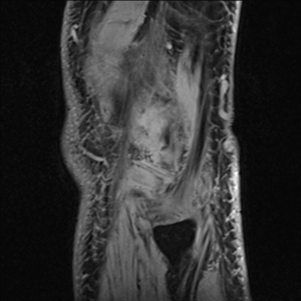 Anterior cruciate ligament tear - ramp lesion (Radiopaedia 71883-82322 Sagittal T1 vibe 17).jpg