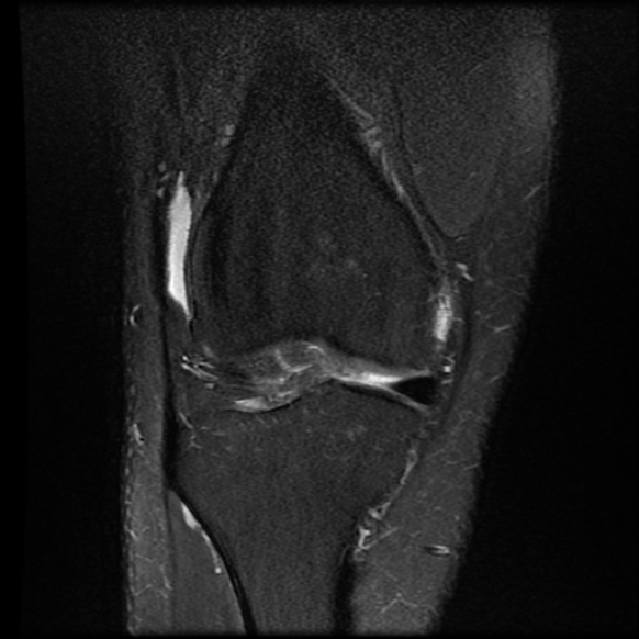 File:Anterior cruciate ligament tear with posteromedial corner injury, bucket-handle meniscal tear and chondral delamination (Radiopaedia 75501-86744 Coronal PD fat sat 9).jpg
