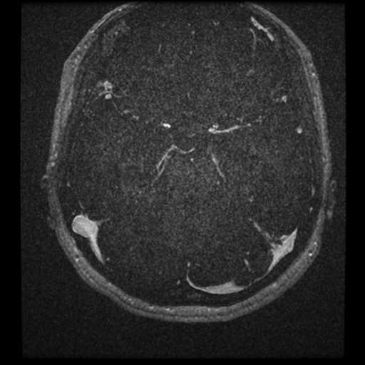 Anterior inferior cerebellar artery vascular loop - type II (Radiopaedia 70991-81209 Axial T1 C+ 2).jpg
