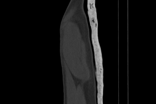 Anterior inferior iliac spine avulsion injury (Radiopaedia 88666-105376 Sagittal bone window 8).jpg