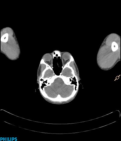 File:Anterior mediastinal seminoma (Radiopaedia 80270-93613 C 3).jpg