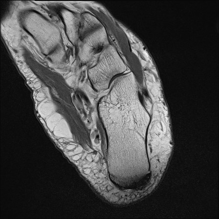File:Anterior talofibular ligament injury - rupture with soft-tissue impingement (Radiopaedia 38765-40928 Axial PD 29).jpg