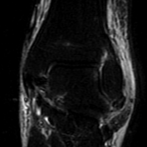 File:Anterior talofibular ligament rupture (Radiopaedia 15831-15484 Coronal STIR 12).jpg