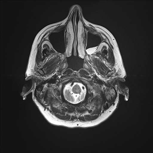 File:Anterior temporal encephalocele (Radiopaedia 82624-96808 Axial T2 2).jpg