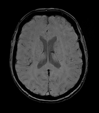 File:Anterior temporal lobe perivascular space (Radiopaedia 40946-43650 Axial SWI 51).png