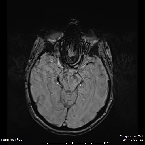 Anterior temporal lobe perivascular space (Radiopaedia 88283-104914 Axial SWI 17).jpg