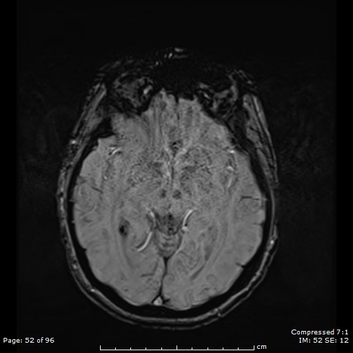 Anterior temporal lobe perivascular space (Radiopaedia 88283-104914 Axial SWI 21).jpg
