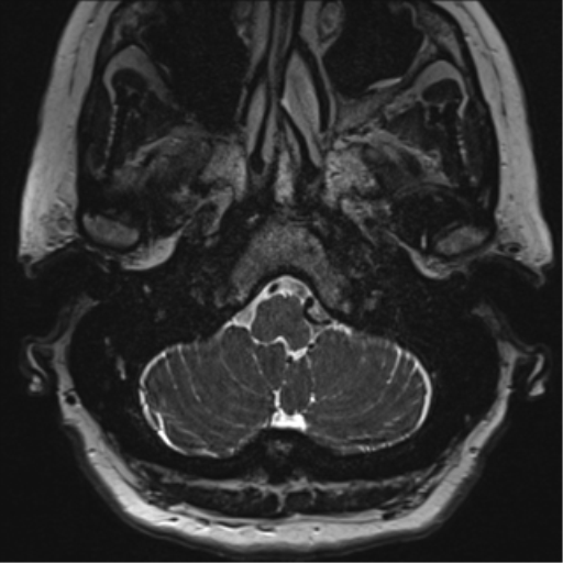 Anterior temporal pole cysts (Radiopaedia 46629-51102 Axial T2 9).png