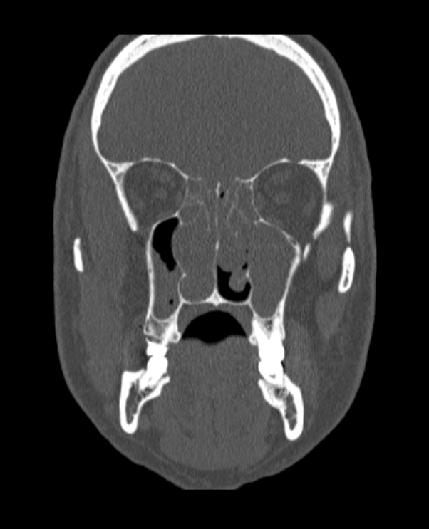 Antrochoanal polyp (Radiopaedia 79011-92169 Coronal bone window 44).jpg
