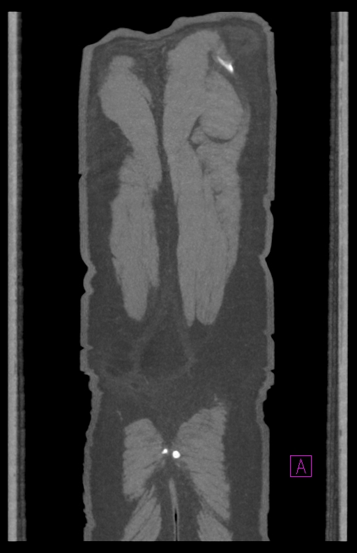 Aortectomy and axillary-bifemoral bypass (Radiopaedia 28303-28545 C 89).jpg