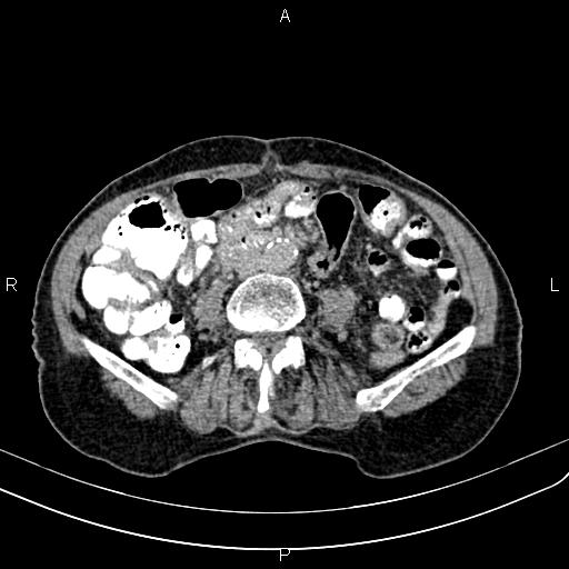 Aortic aneurysm and Lemmel syndrome (Radiopaedia 86499-102554 Axial C+ delayed 45).jpg