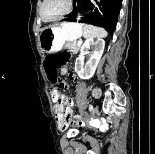 Aortic aneurysm and Lemmel syndrome (Radiopaedia 86499-102554 D 62).jpg