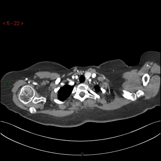 File:Aortic arch origin of left vertebral artery (Radiopaedia 51520-57286 A 21).jpg