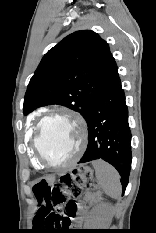 Aortic coarctation with aneurysm (Radiopaedia 74818-85828 B 128).jpg
