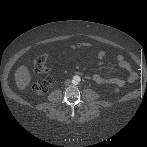 File:Aortic dissection- Stanford A (Radiopaedia 35729-37268 C 29).jpg