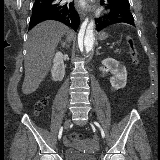 Aortic dissection- Stanford A (Radiopaedia 35729-37268 F 21).jpg