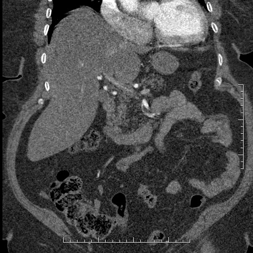 File:Aortic dissection- Stanford A (Radiopaedia 35729-37268 F 46).jpg