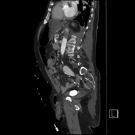 Aortic dissection (CTPA) (Radiopaedia 75506-86750 G 67).jpg