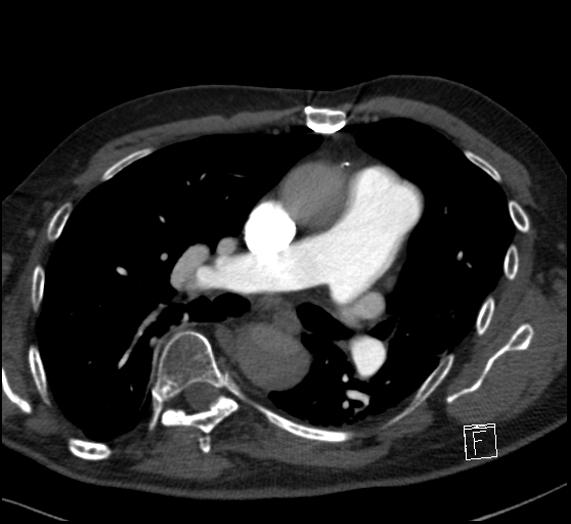 File:Aortic dissection (CTPA) (Radiopaedia 75506-86751 Axial C+ CTPA 66).jpg