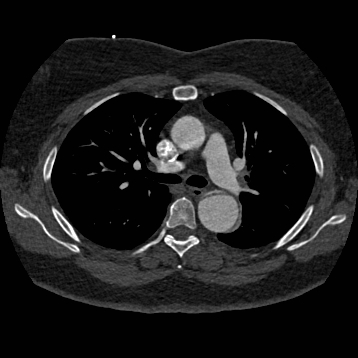 File:Aortic dissection (Radiopaedia 57969-64959 A 128).jpg
