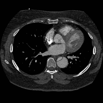 Aortic dissection (Radiopaedia 57969-64959 A 183).jpg