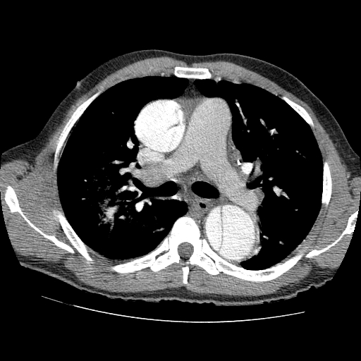 File:Aortic dissection - Stanford A -DeBakey I (Radiopaedia 28339-28587 B 35).jpg